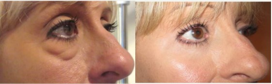 Eyebag Removal Before and After