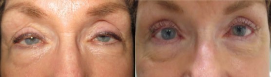 Eyelid Retraction Repair Before and After