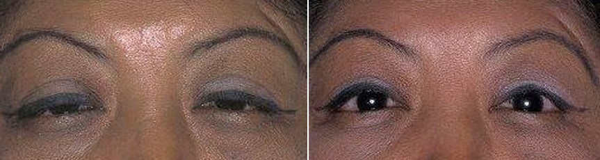Upper Eyelid Retraction Before and After