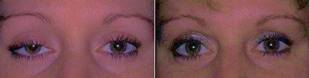 Upper Eyelids Repair Before and After