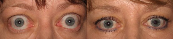 Orbital Decompression for Thyroid Eye Disease Before and After