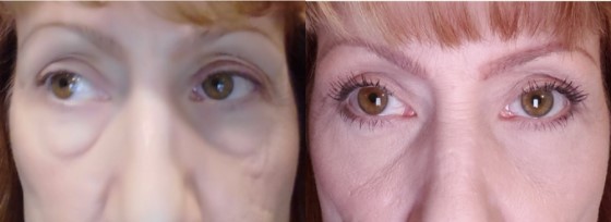 Upper Eyelid and Lower Eye Bags Surgery Before and After