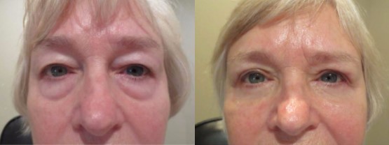 Upper and Lower Blepharoplasty Before and After